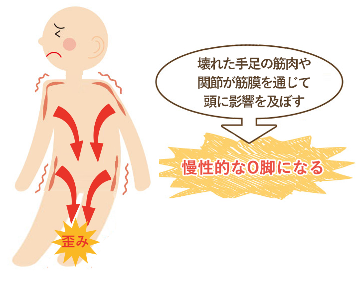 この期間が長く続く程、筋肉などの軟部組織にカルシウム沈着や癒着がおこり慢性的なO脚になってしまいます。