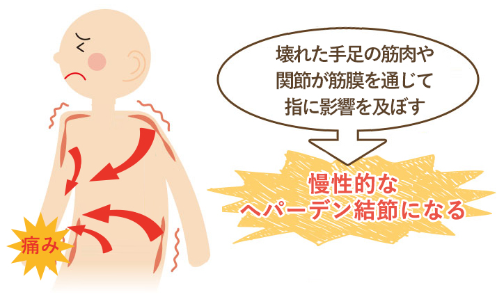 この期間が長く続く程、筋肉などの軟部組織にカルシウム沈着や癒着がおこり慢性的なへパーデン結節になってしまいます。
