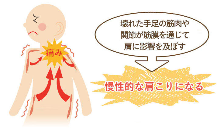 この期間が長く続く程、筋肉などの軟部組織にカルシウム沈着や癒着がおこり慢性的な肩こりになってしまいます。