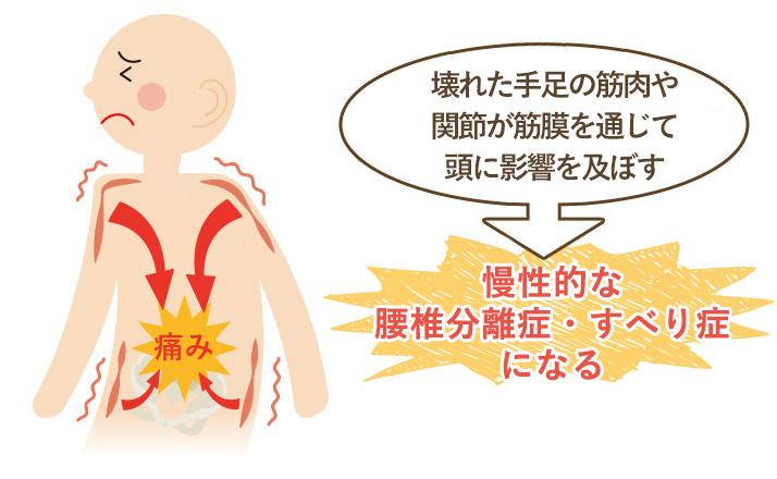 この期間が長く続く程、筋肉などの軟部組織にカルシウム沈着や癒着がおこり慢性的な腰椎分離症・すべり症になってしまいます。
