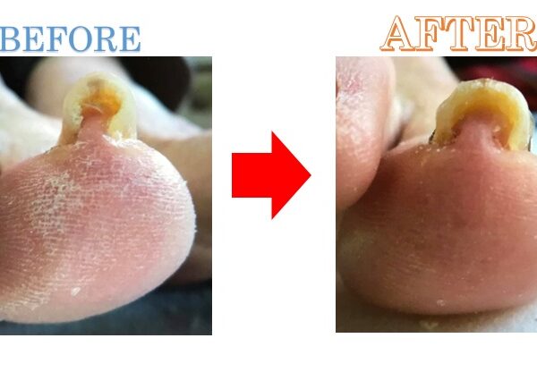 巻き爪が再発。初回で痛みなく帰れました！